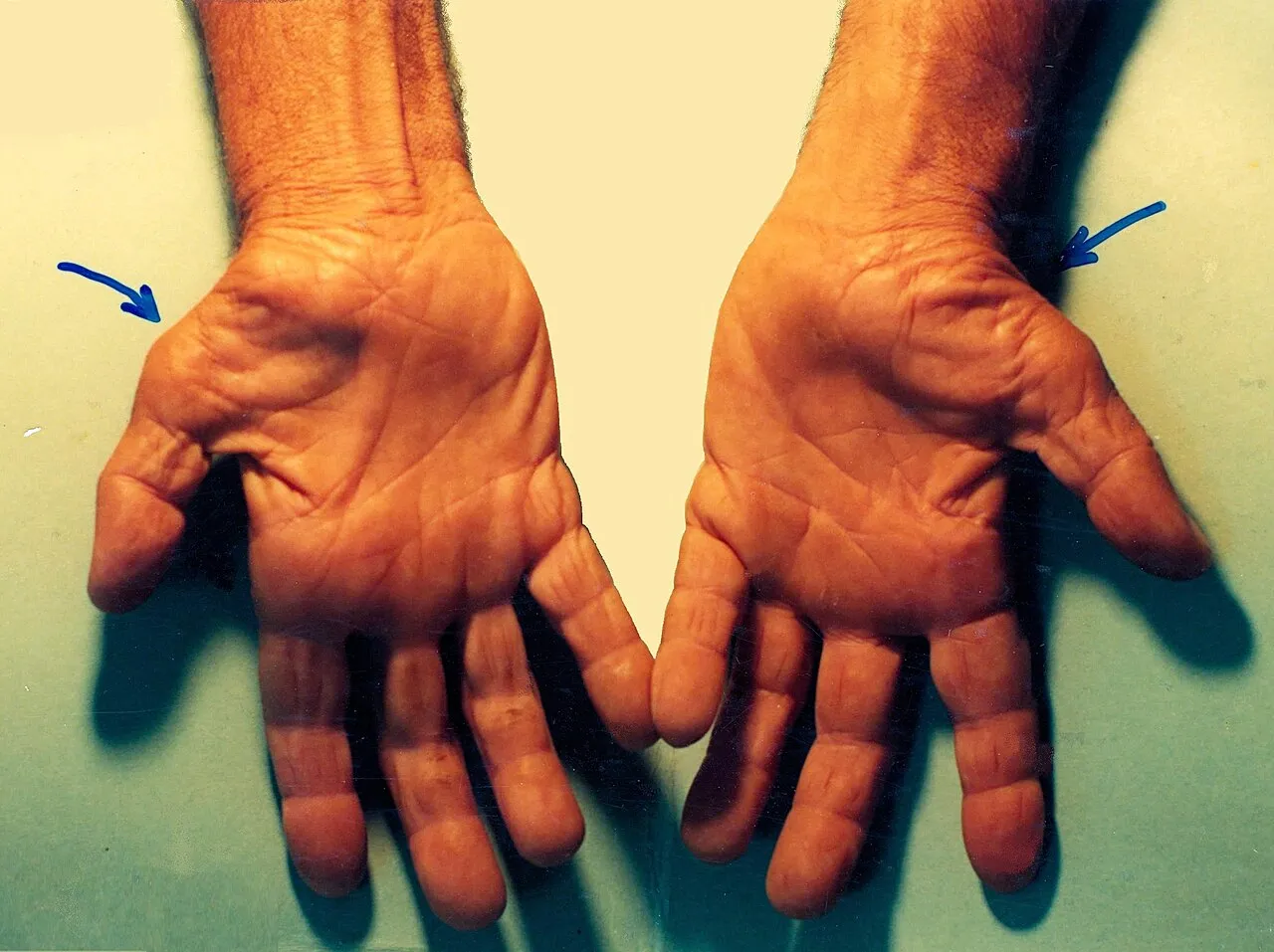 Explanation of carpal tunnel syndrome symptoms and median neuropathy causes